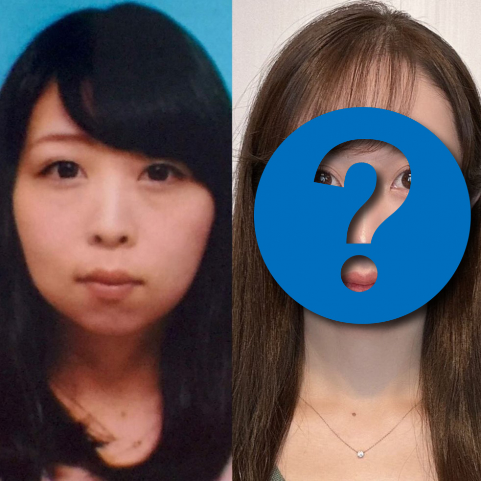 ✨花百万,美不持久?整形女星:撕开绷带,我才发现…
