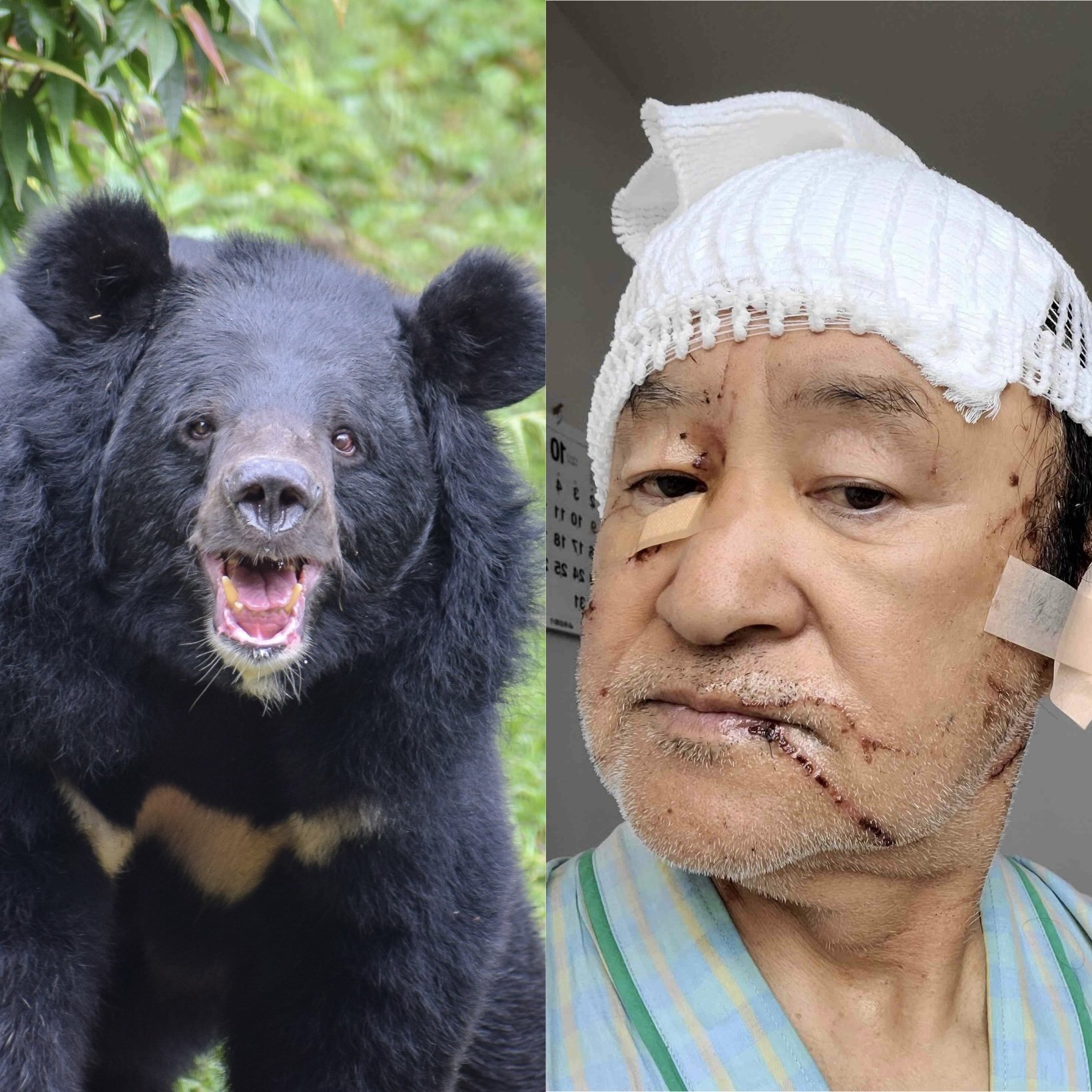 ⚠️ 惨!头皮被剥!幸存者讲述熊的恐怖!