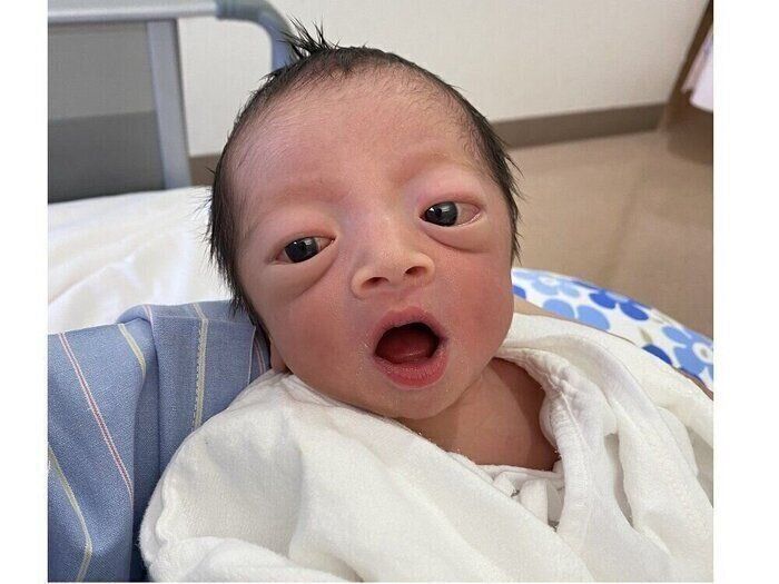 👶儿子出生就发现眼球突出，9个月后头颅手术！【罕见病逆袭