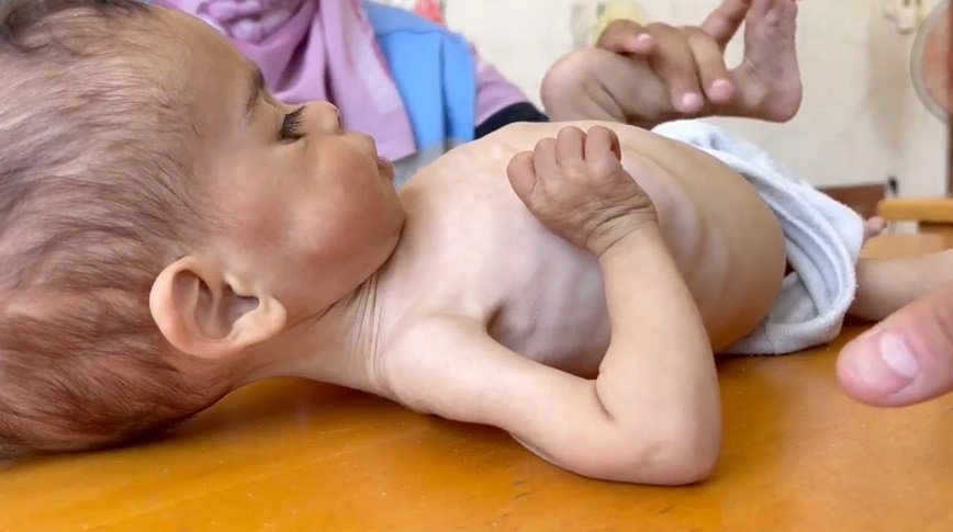 👶💔 婴儿瘦臂如拇指，加沙的绝望！