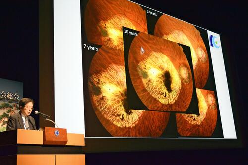 ✨十年如一日！失明患者重见光明，竟没复发？！