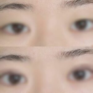 🎁孩子整容当生日礼？背后的“爱”与痛！ 封面